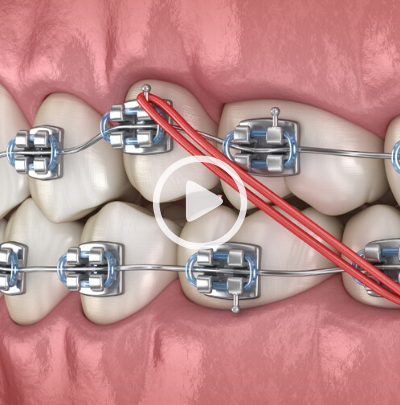 Caring for Your Braces During Covid-19 Part 1- Wearing Rubber Bands