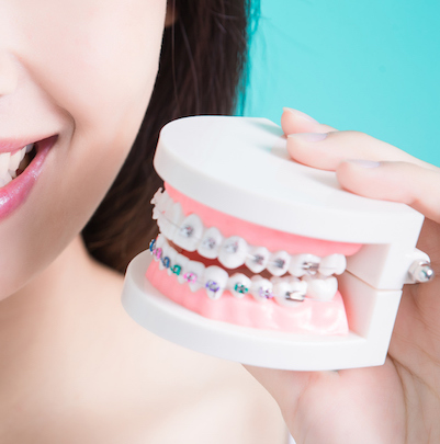 Braces vs Clear Aligners