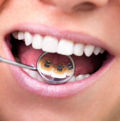 Braces that Work from Behind the Teeth (Lingual Braces)