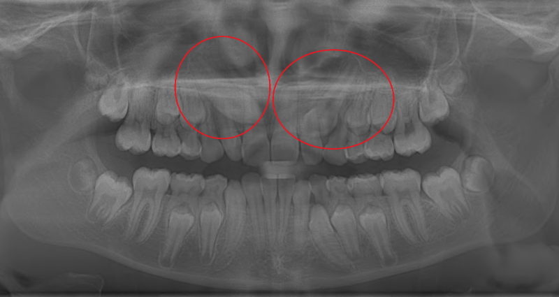  Impacted canine teeth shown in x-ray 