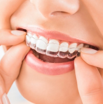 Keeping your Teeth Straight After Orthodontics