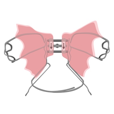 What to Expect from Your Removable Arch Expander