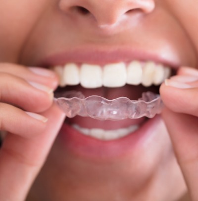 Will I Need to Wear a Retainer After Braces? Guide to Permanent Retainers