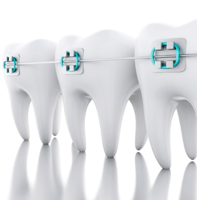 Broken Braces? What to do if a Bracket or Wire Breaks (Don't Panic!)