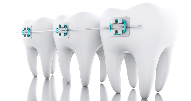a dental wire brace across the front of white teeth