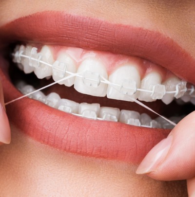 Flossing with Braces – How to Floss When you Have Braces