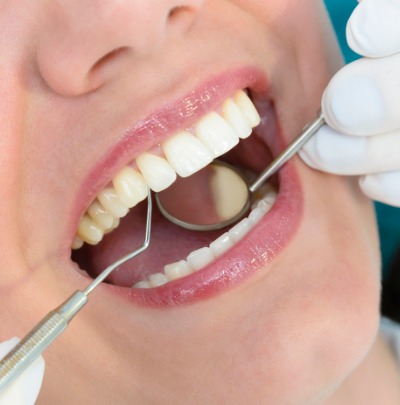 What is Gingivitis? Causes, Symptoms and Treatment