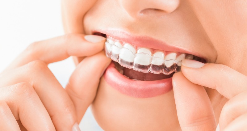 Lady smiling holding her orthodontic retainer, this allows for teeth to remain straight