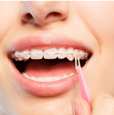 What Are Elastics for Braces?