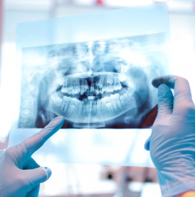 Everything You Need to Know about X-rays and Starting Your Orthodontic Treatment