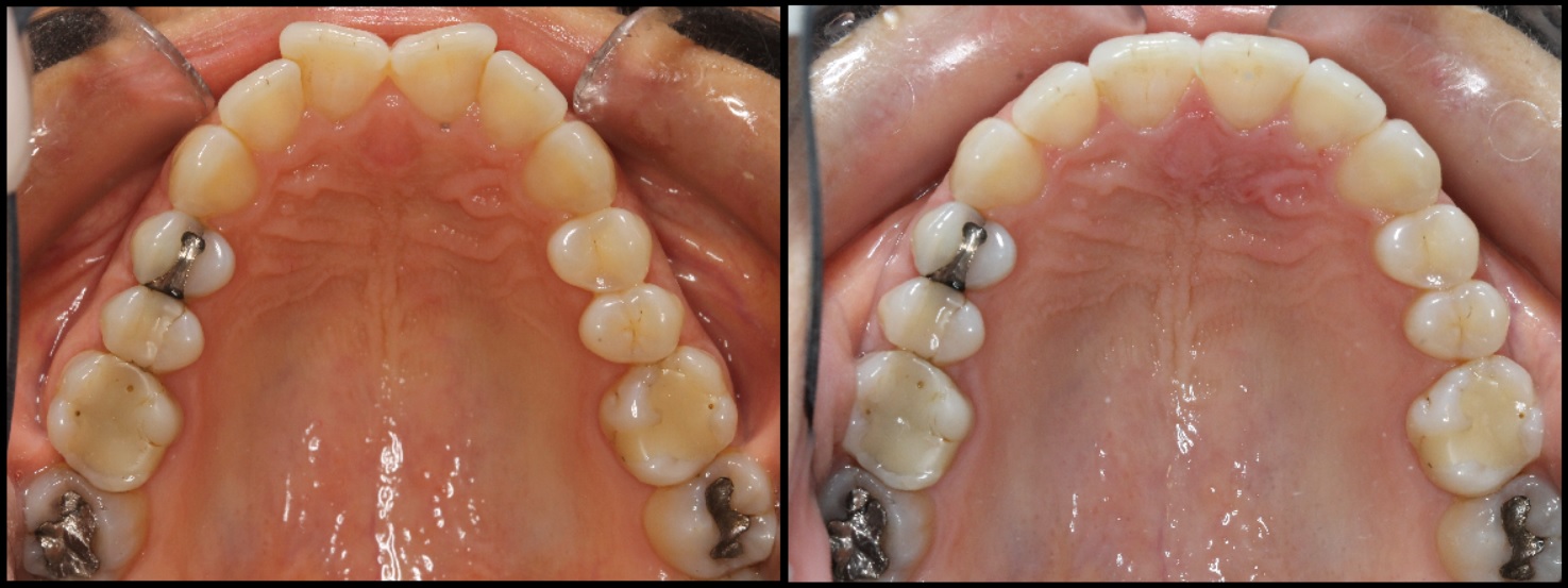 Butterfly incisors fixed with invisalign 