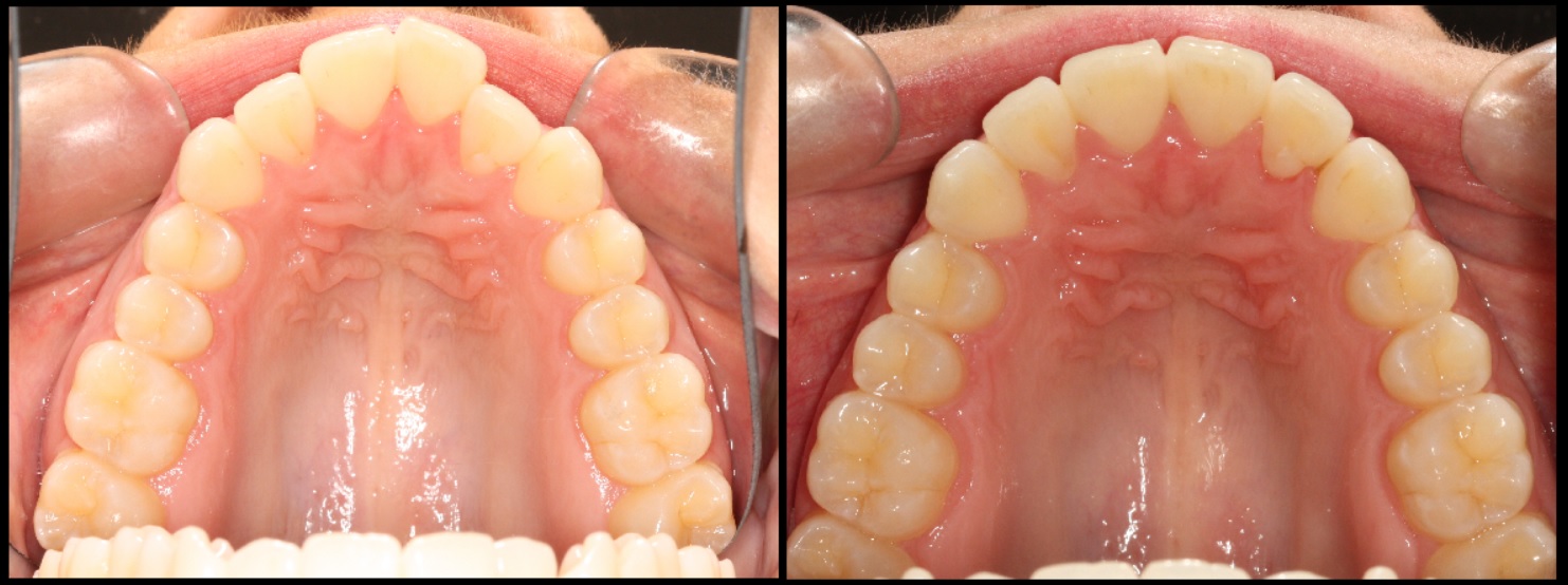 Alignment and arch shape of upper teeth from clear aligners