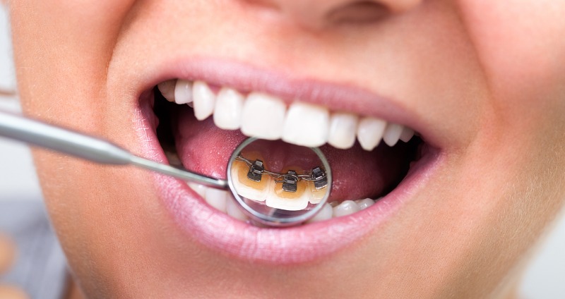 A female patient holding a mirror to show her lingual braces (braces behind the teeth)