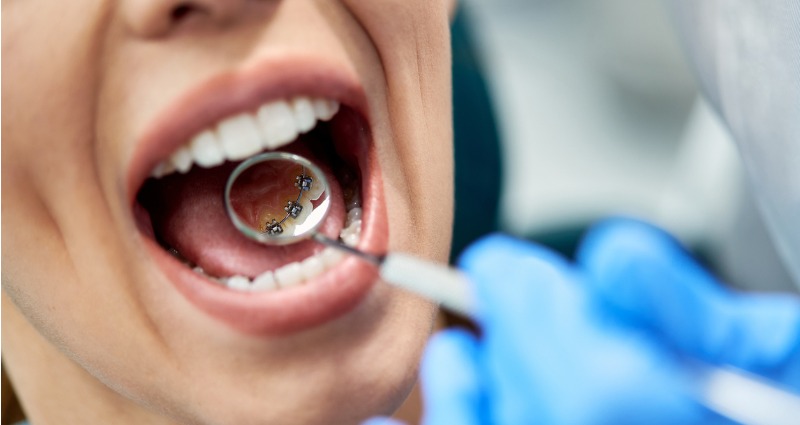 An orthodontist examining a patient’s lingual braces for their overbite.