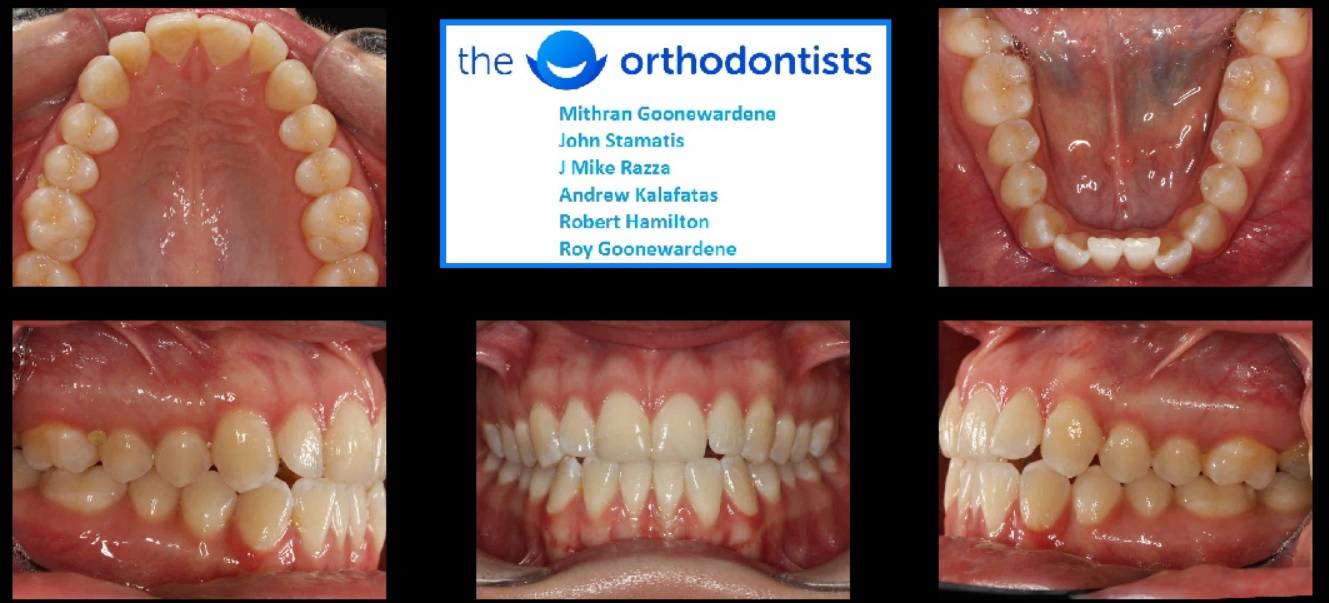 Invisalign Before And After Photos Australia 19