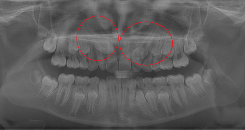 Impacted canine teeth shown in x-ray
