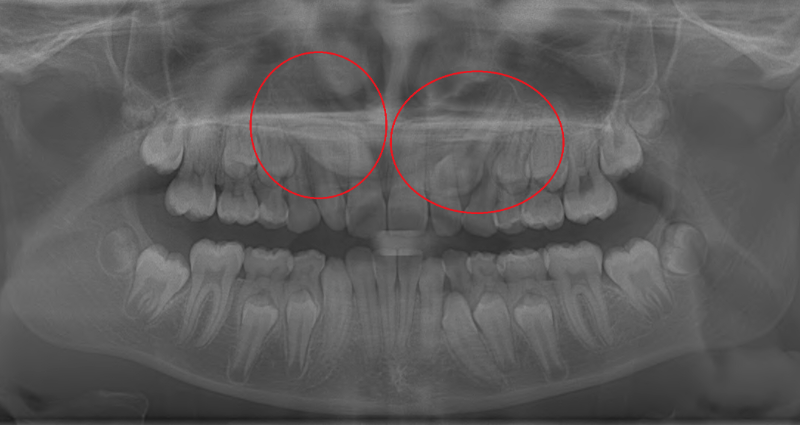 do you lose your canine teeth