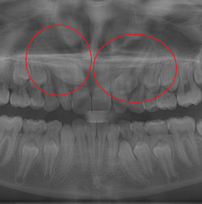 Can Orthodontics Help with Impacted Teeth?