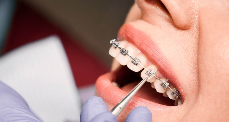 Young female at orthodontic clinic having her braces tightened 