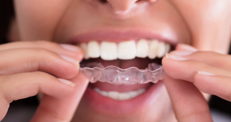 a young woman putting an invisible retainer on to her teeth