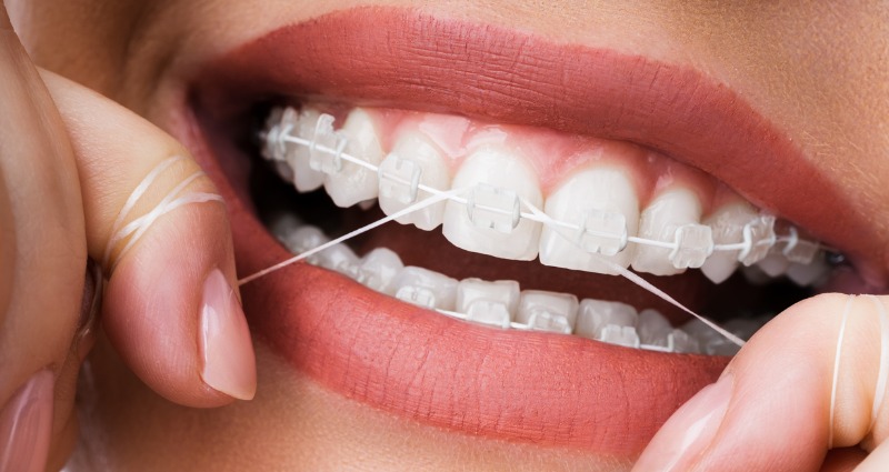 Female with orthodontic braces flossing