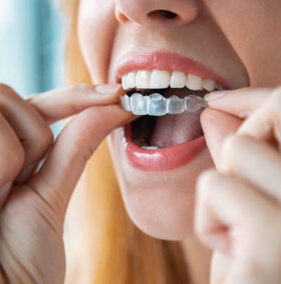 Lost or Broken Retainers? Why You Need to Act Fast
