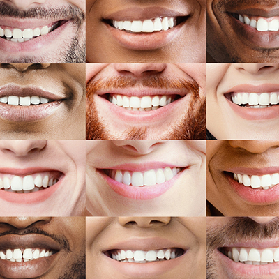 Treating Mild Irregularities of the Teeth Can Be A Real Dilemma for the Patient and Orthodontist