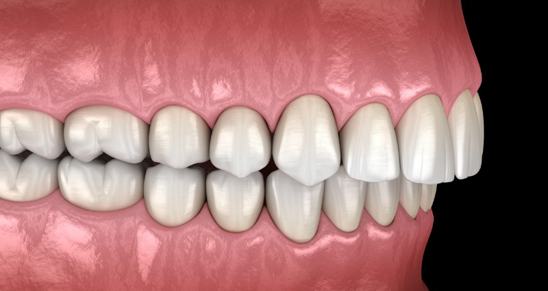 A 3d render showing an overbite before fixing it