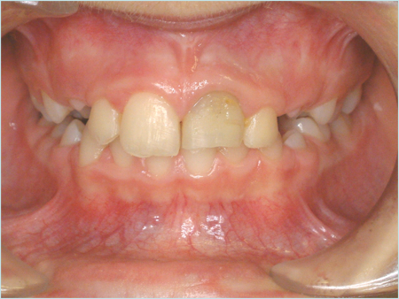 example of dark tooth 