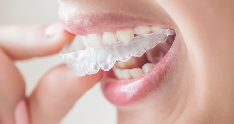 Young woman demonstrating how to wear an orthodontic retainer to ensure her teeth do not shift back. 