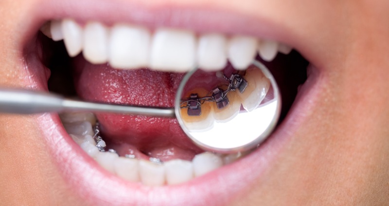 Orthodontist  showing a close up look of lingual braces (brace behind the teeth) 