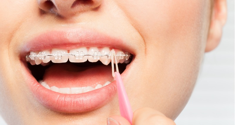 Close up of a woman attaching elastics to her braces.